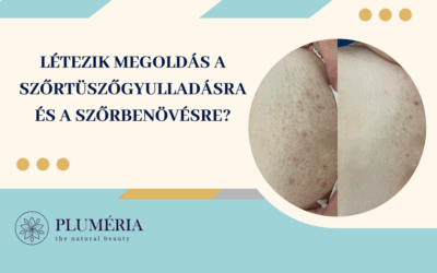LÉTEZIK MEGOLDÁS A SZŐRTÜSZŐGYULLADÁSRA ÉS A SZŐRBENÖVÉSRE?