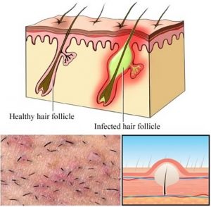 Létezik megoldás a szőrtüszőgyulladásra és a szőrbenövésre?