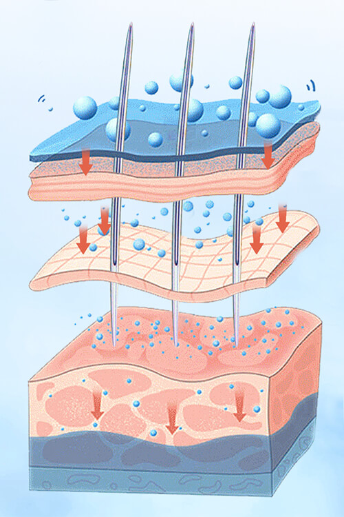 SQT bio mikrotűs kezelés, spongilla spicules, szivacs, tű, bőrmegújítás, kollagén, Pluméria szépségszalon, Budapest, 13. kerület